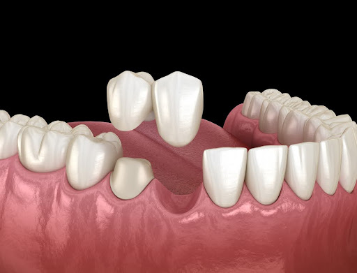 Dental Bridges