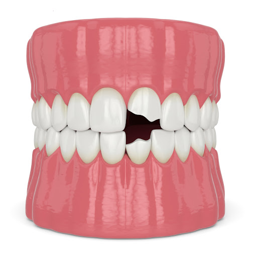 Dental Crowns